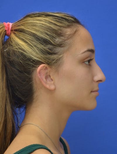 Rhinoplasty Before & After Gallery - Patient 337651 - Image 1