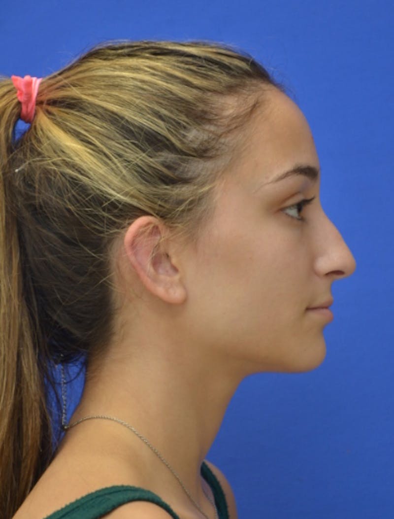 Rhinoplasty Before & After Gallery - Patient 337651 - Image 1