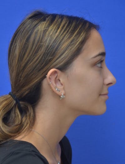 Rhinoplasty Before & After Gallery - Patient 337651 - Image 2