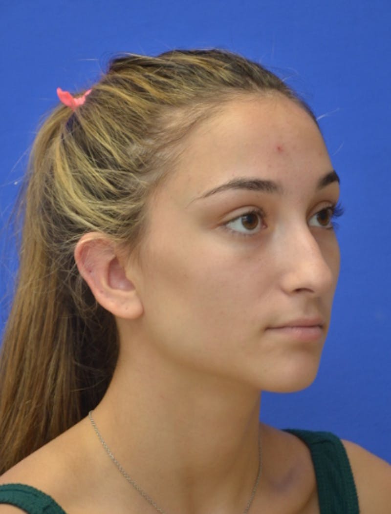 Rhinoplasty Before & After Gallery - Patient 337651 - Image 3