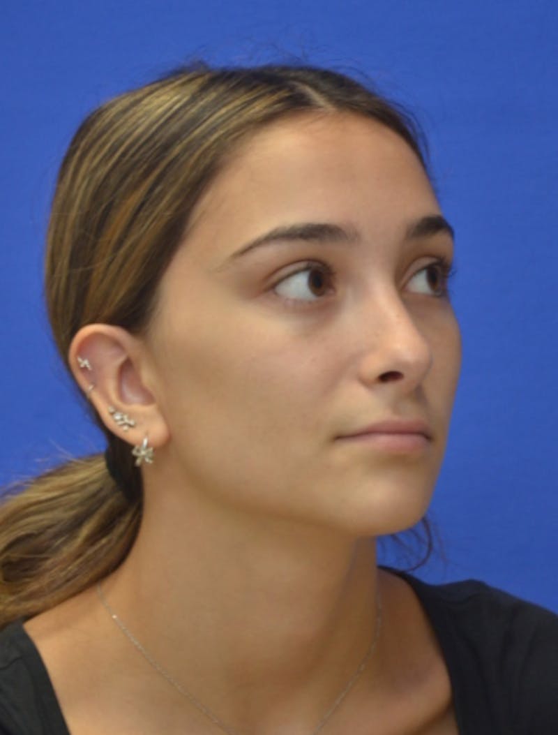 Rhinoplasty Before & After Gallery - Patient 337651 - Image 4