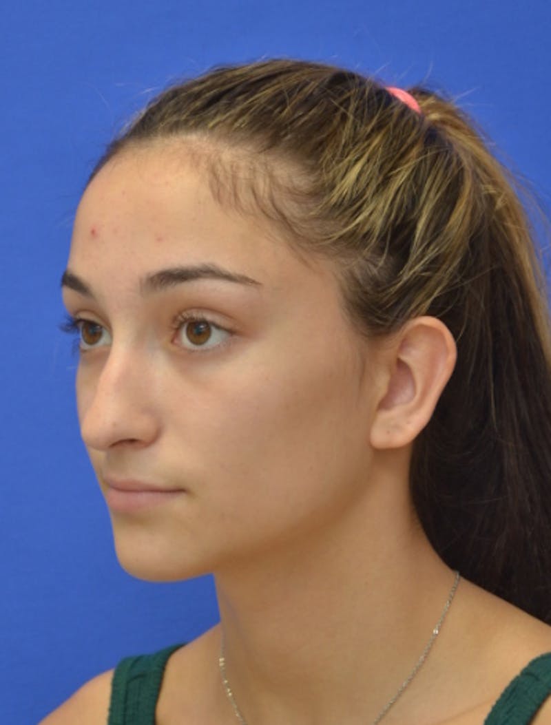 Rhinoplasty Before & After Gallery - Patient 337651 - Image 5
