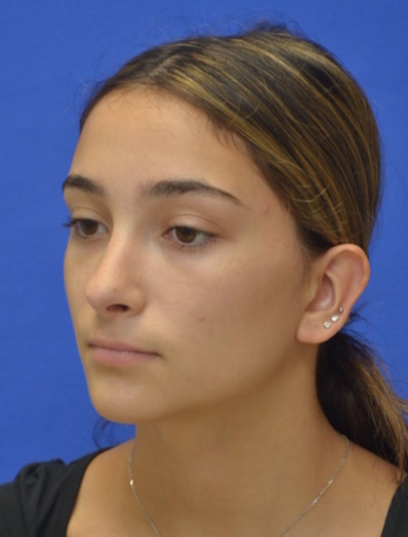 Rhinoplasty Before & After Gallery - Patient 337651 - Image 6