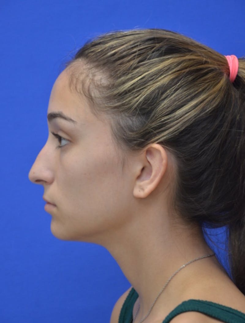 Rhinoplasty Before & After Gallery - Patient 337651 - Image 7