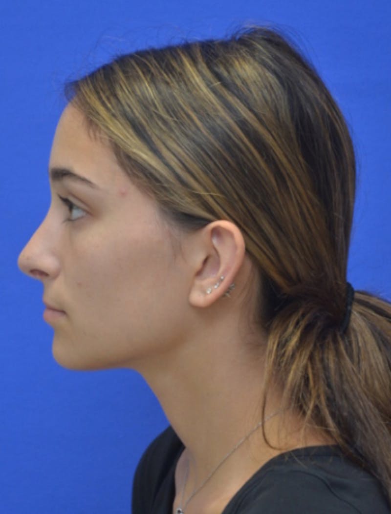 Rhinoplasty Before & After Gallery - Patient 337651 - Image 8