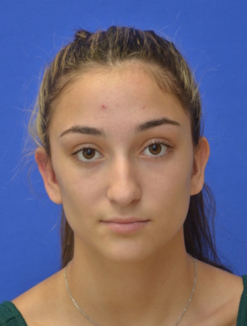Rhinoplasty Before & After Gallery - Patient 337651 - Image 9