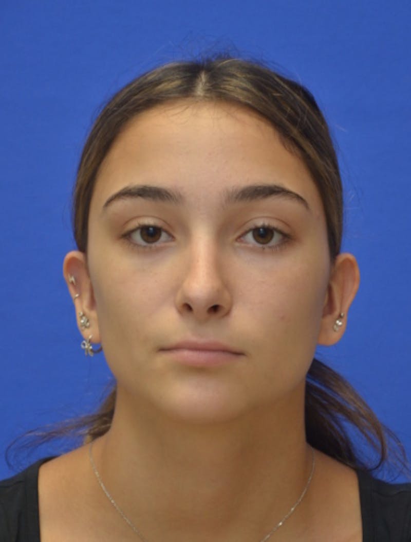 Rhinoplasty Before & After Gallery - Patient 337651 - Image 10