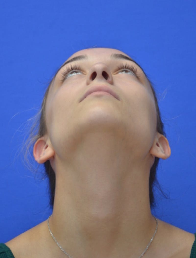 Rhinoplasty Before & After Gallery - Patient 337651 - Image 11