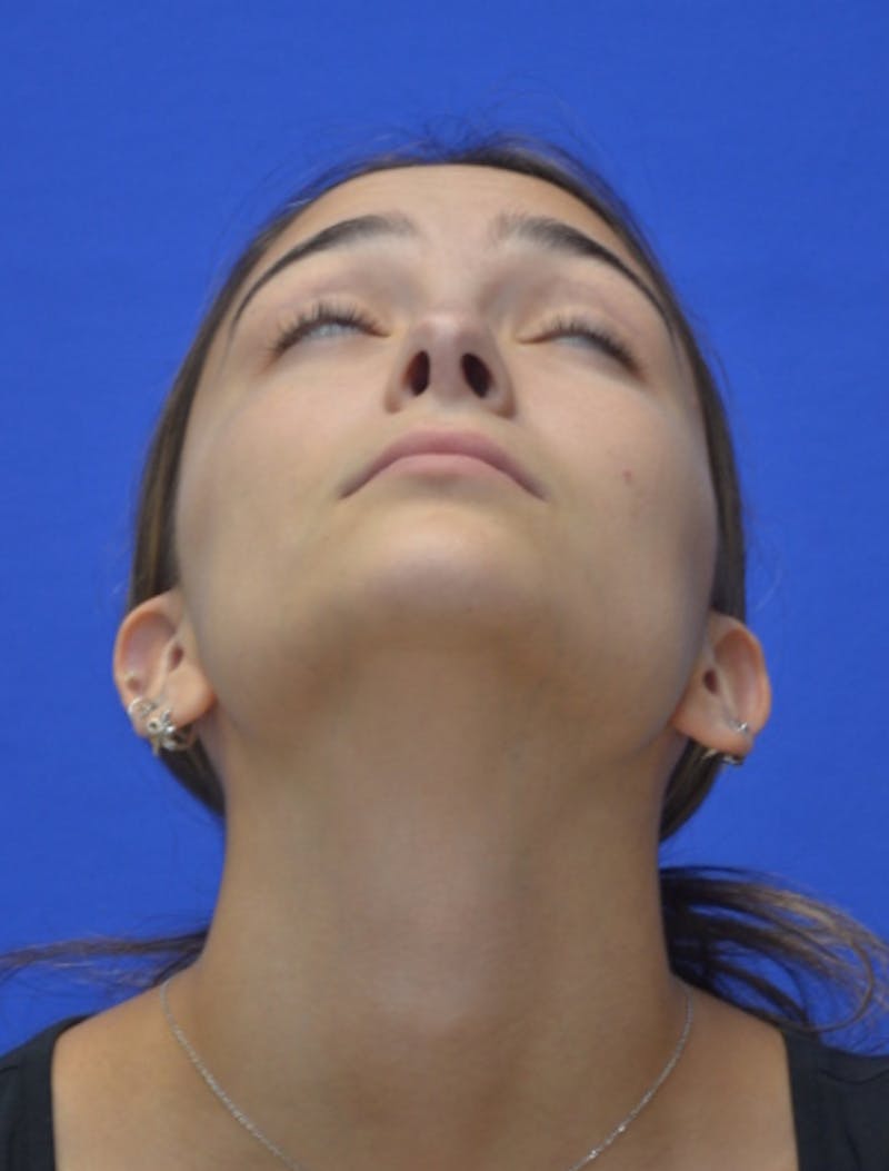Rhinoplasty Before & After Gallery - Patient 337651 - Image 12