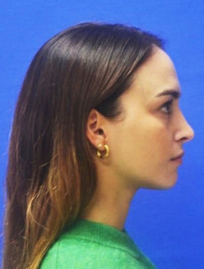 Rhinoplasty Before & After Gallery - Patient 381416 - Image 2
