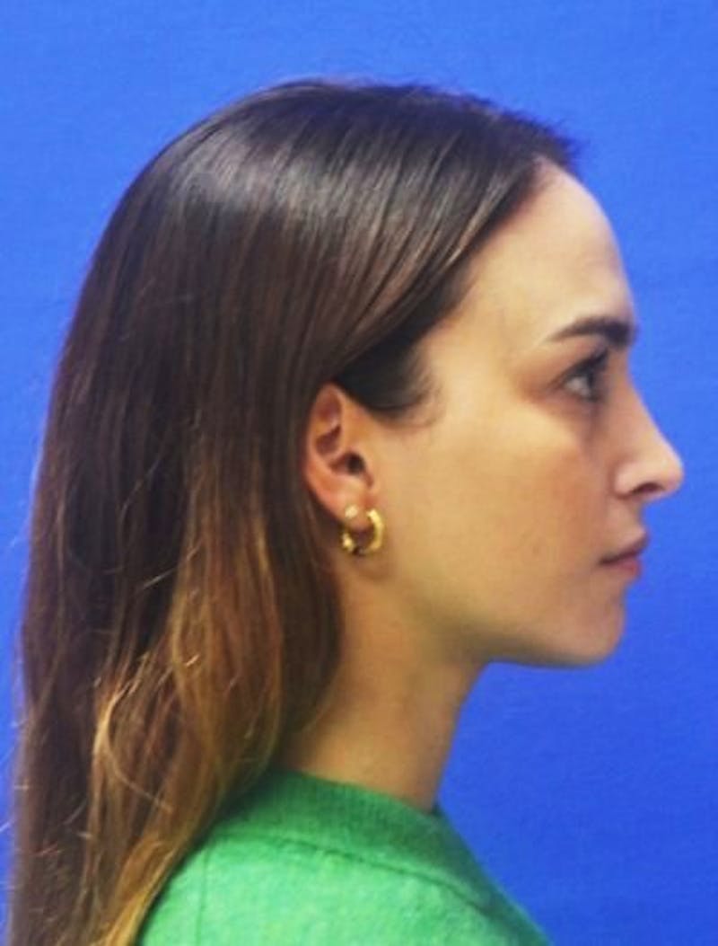 Rhinoplasty Before & After Gallery - Patient 381416 - Image 2