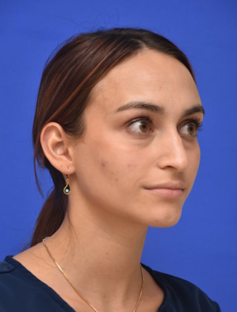 Rhinoplasty Before & After Gallery - Patient 381416 - Image 3