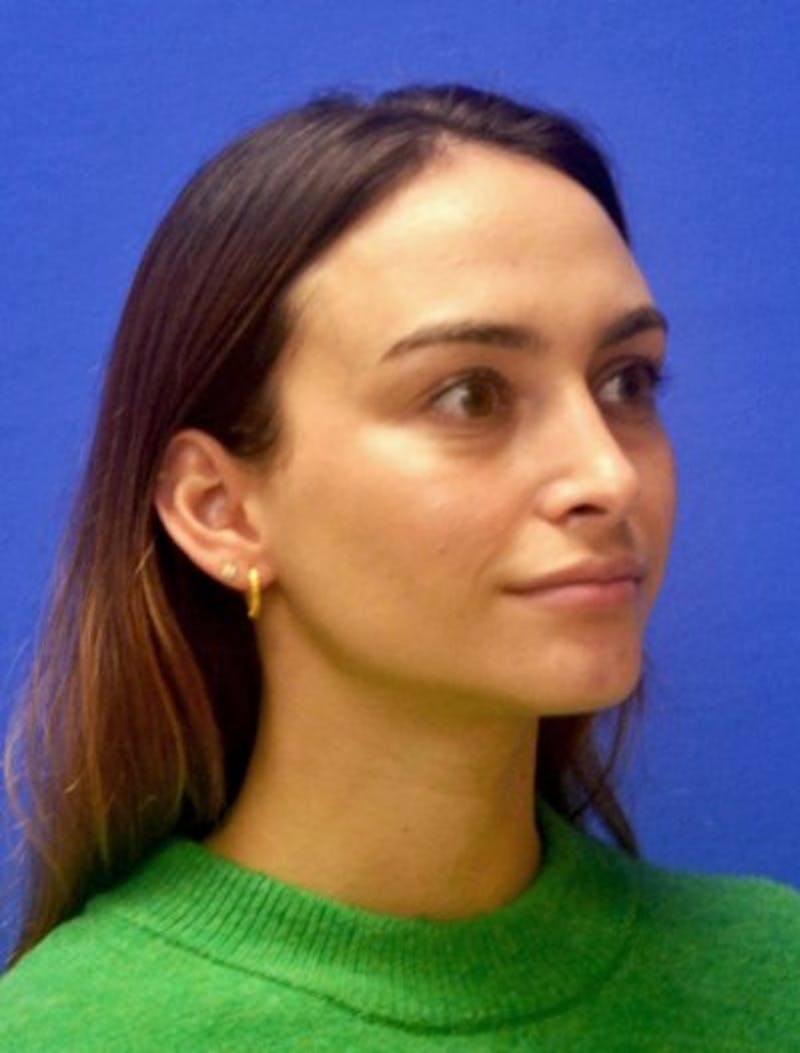 Rhinoplasty Before & After Gallery - Patient 381416 - Image 4