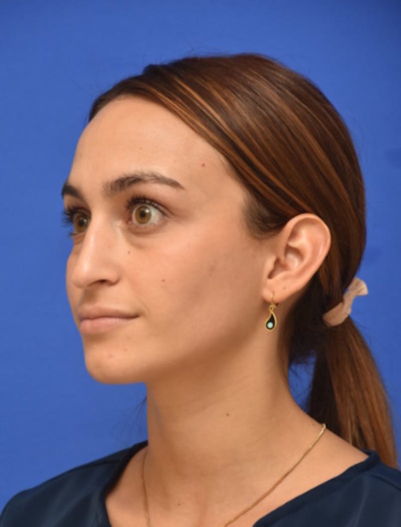 Rhinoplasty Before & After Gallery - Patient 381416 - Image 5