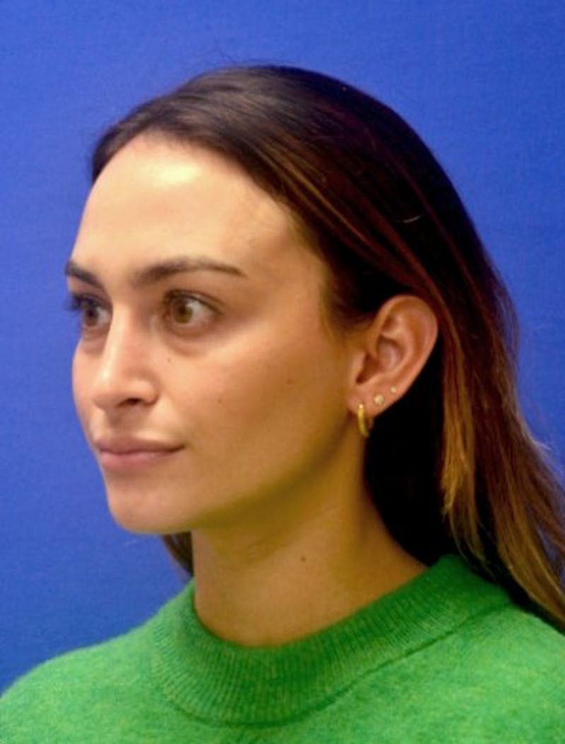Rhinoplasty Before & After Gallery - Patient 381416 - Image 6