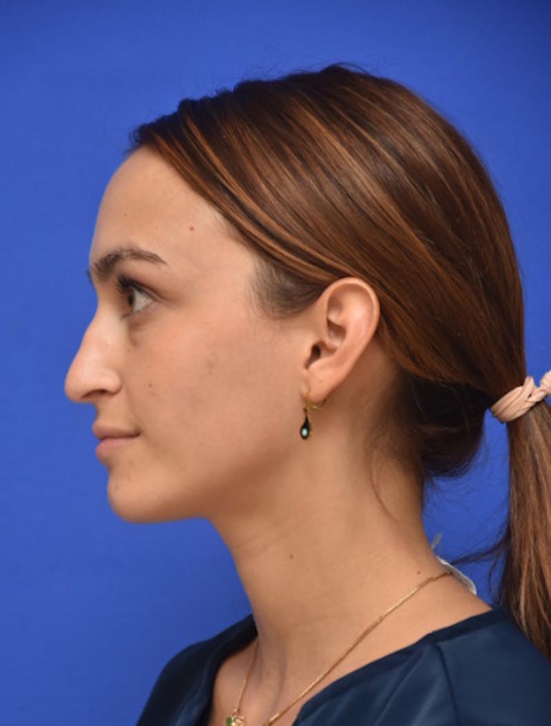Rhinoplasty Before & After Gallery - Patient 381416 - Image 7