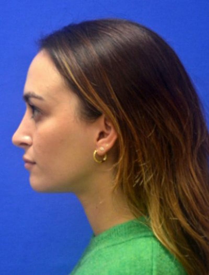 Rhinoplasty Before & After Gallery - Patient 381416 - Image 8