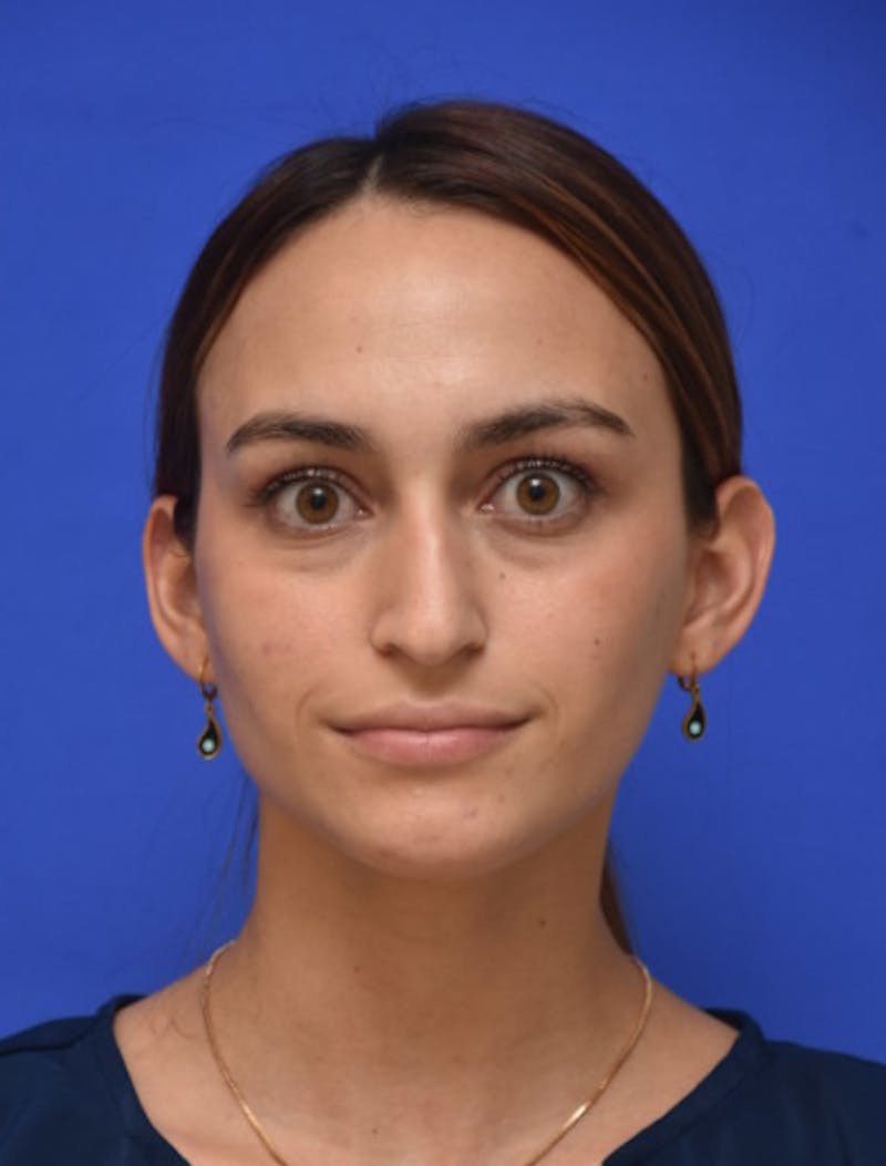 Rhinoplasty Before & After Gallery - Patient 381416 - Image 9