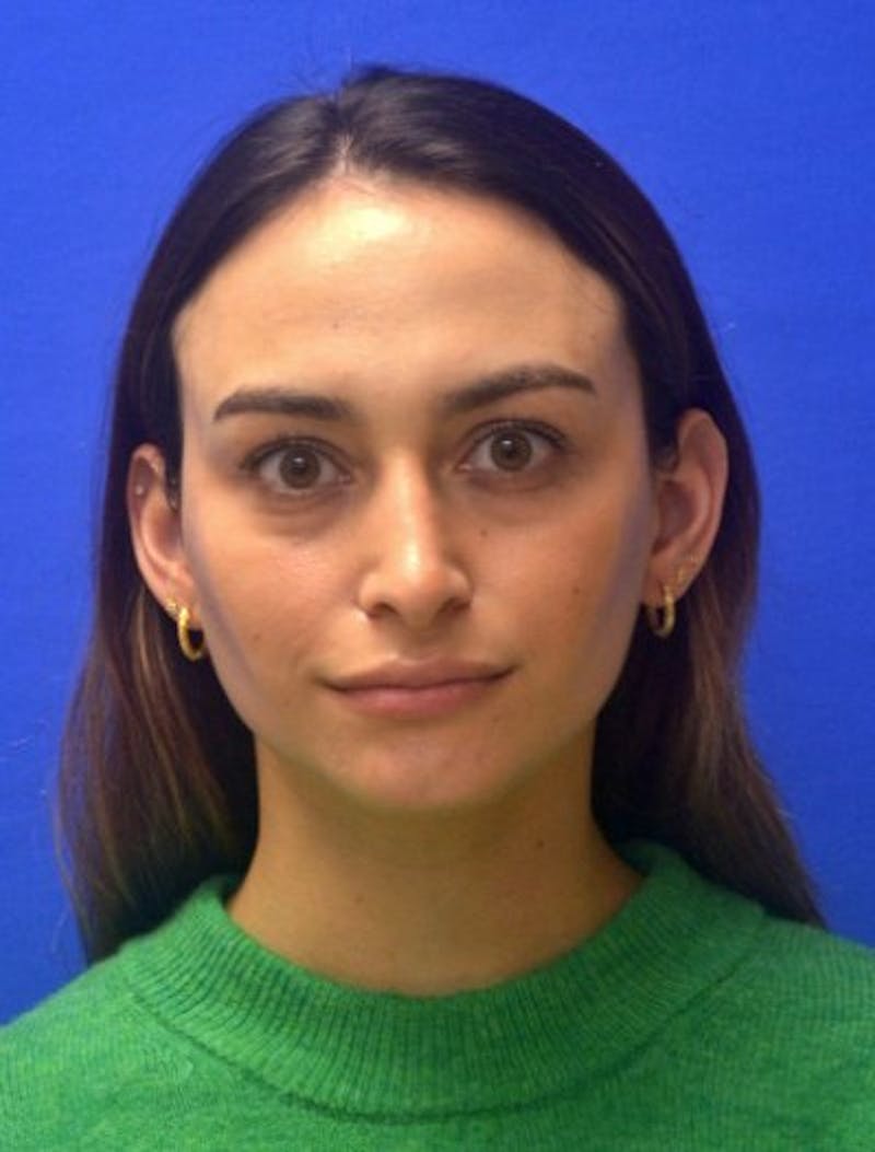 Rhinoplasty Before & After Gallery - Patient 381416 - Image 10