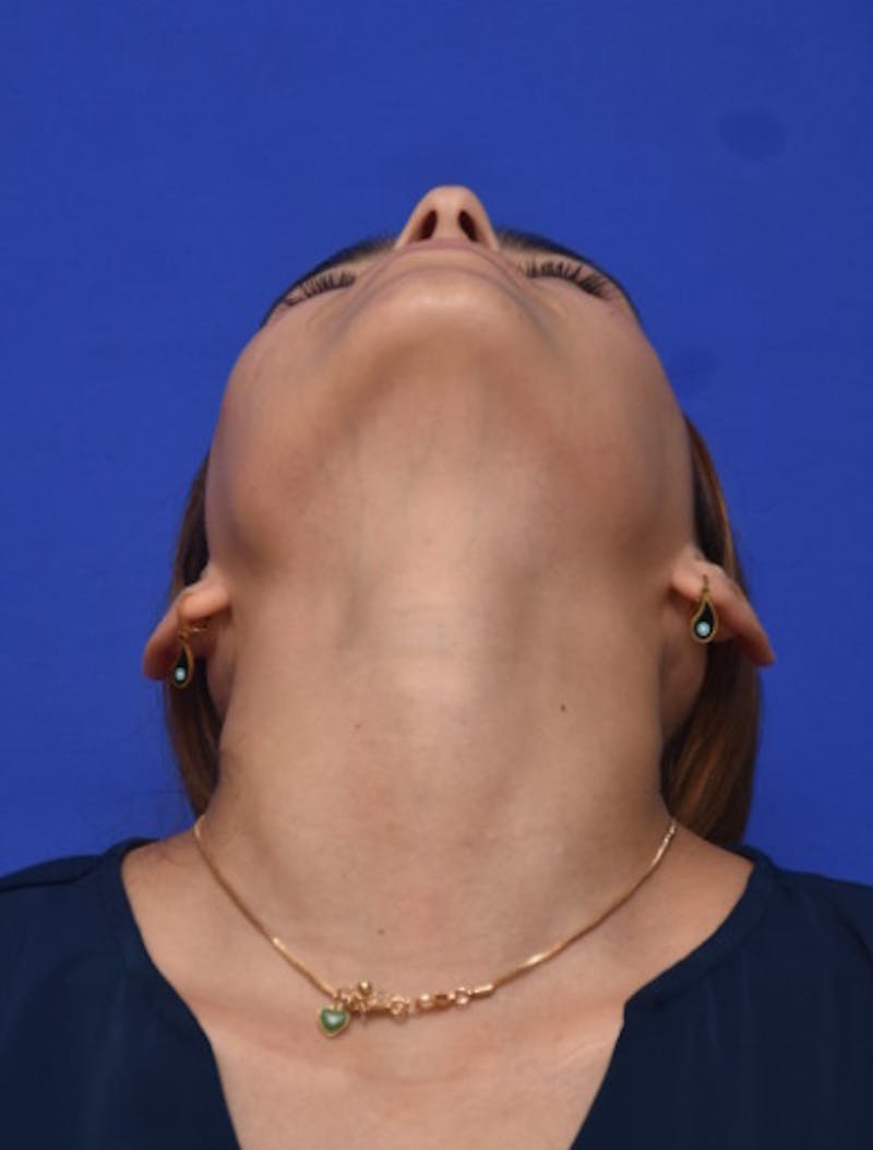 Rhinoplasty Before & After Gallery - Patient 381416 - Image 11