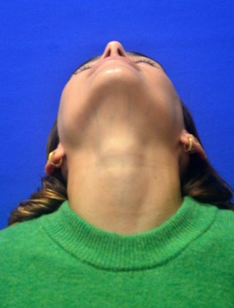 Rhinoplasty Before & After Gallery - Patient 381416 - Image 12