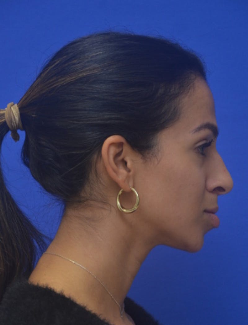 Rhinoplasty Before & After Gallery - Patient 262633 - Image 1