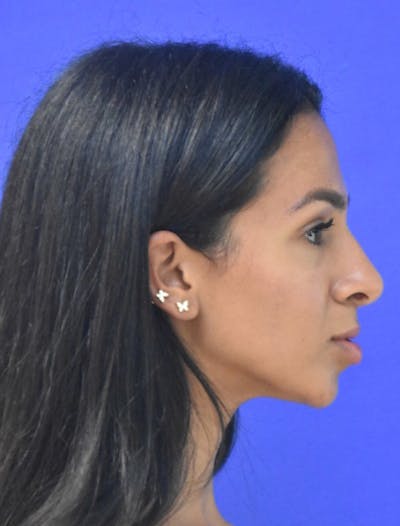 Rhinoplasty Before & After Gallery - Patient 262633 - Image 2