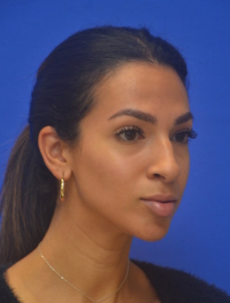 Rhinoplasty Before & After Gallery - Patient 262633 - Image 3