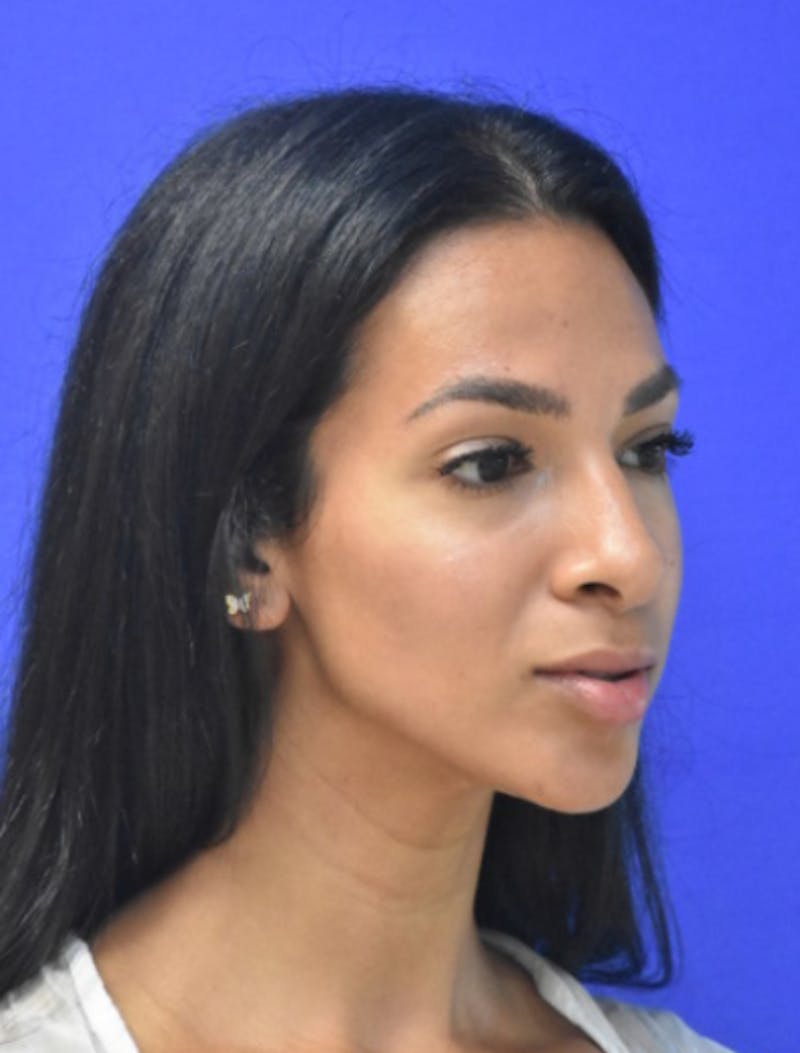 Rhinoplasty Before & After Gallery - Patient 262633 - Image 4