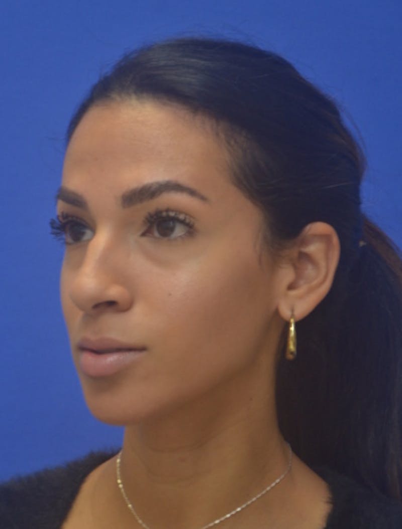 Rhinoplasty Before & After Gallery - Patient 262633 - Image 5