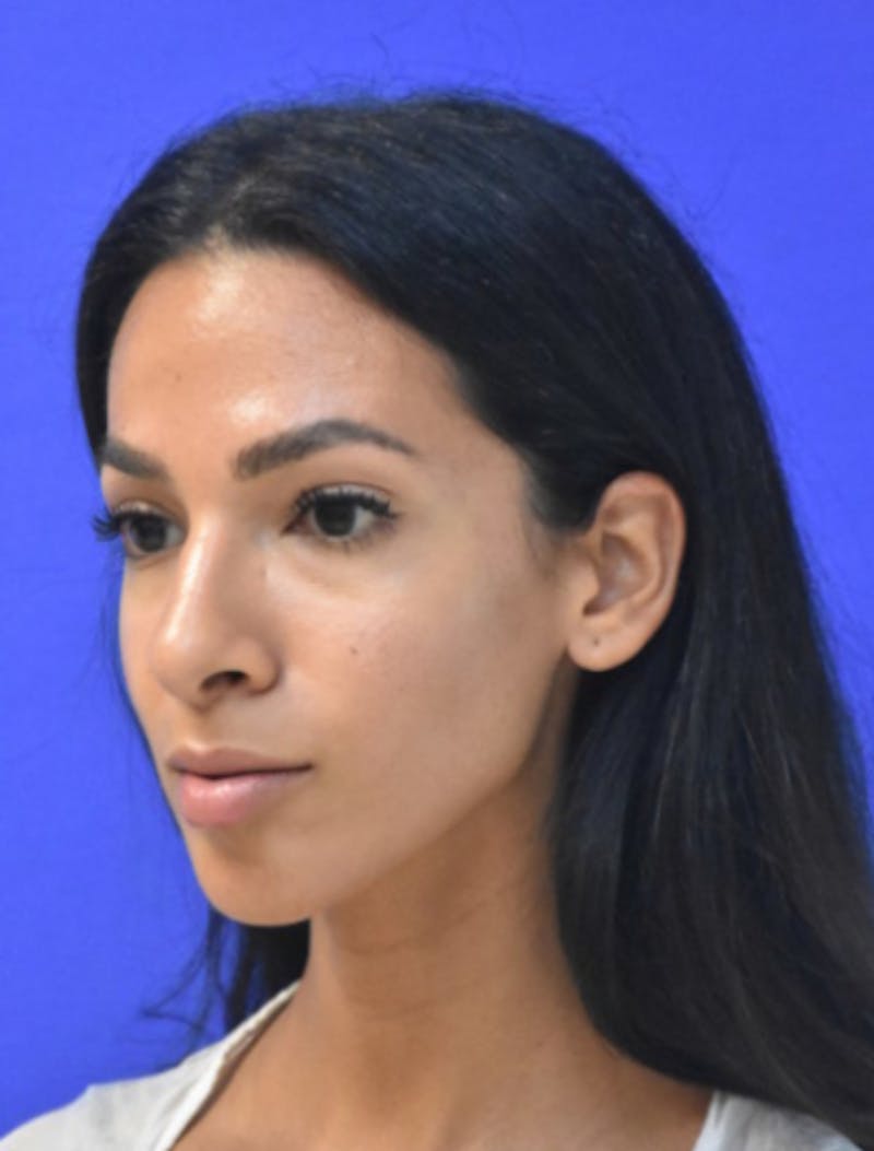Rhinoplasty Before & After Gallery - Patient 262633 - Image 6