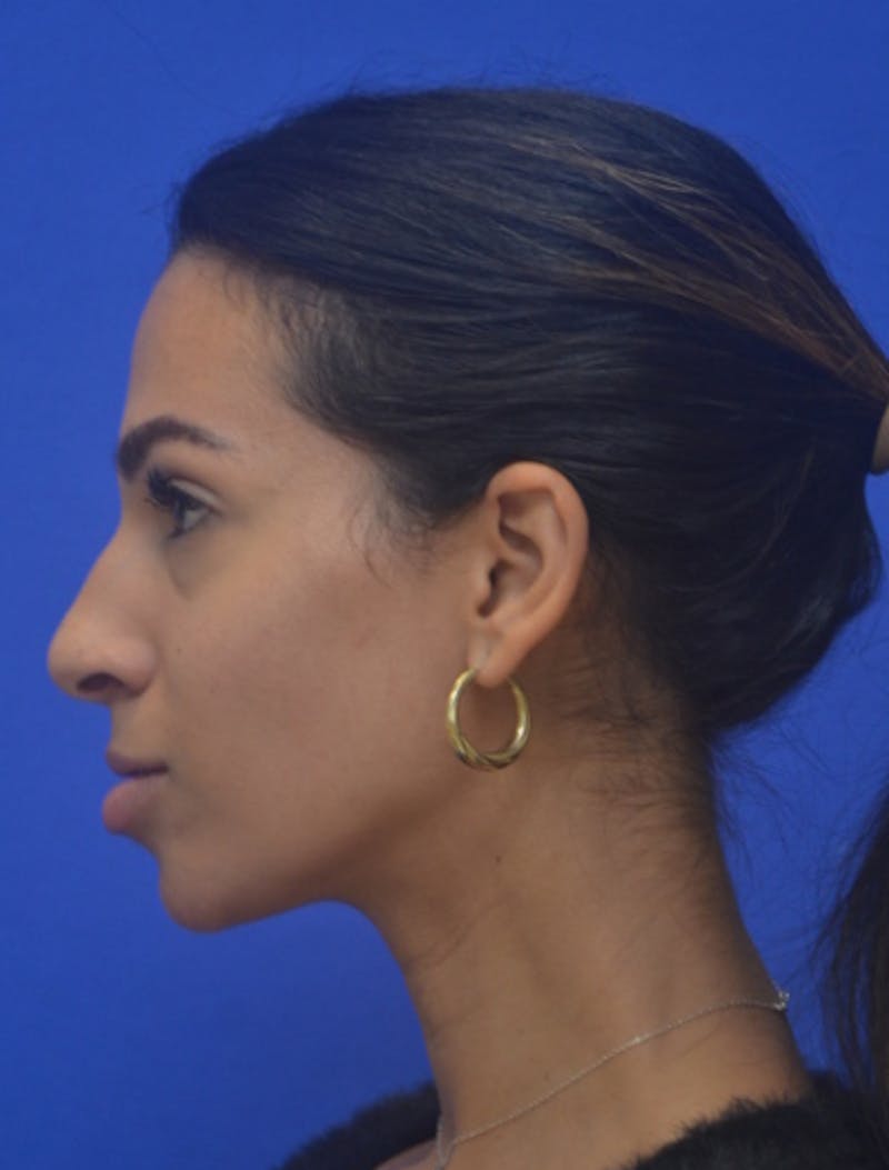 Rhinoplasty Before & After Gallery - Patient 262633 - Image 7
