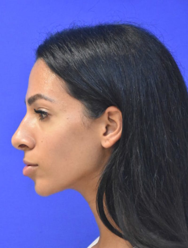 Rhinoplasty Before & After Gallery - Patient 262633 - Image 8