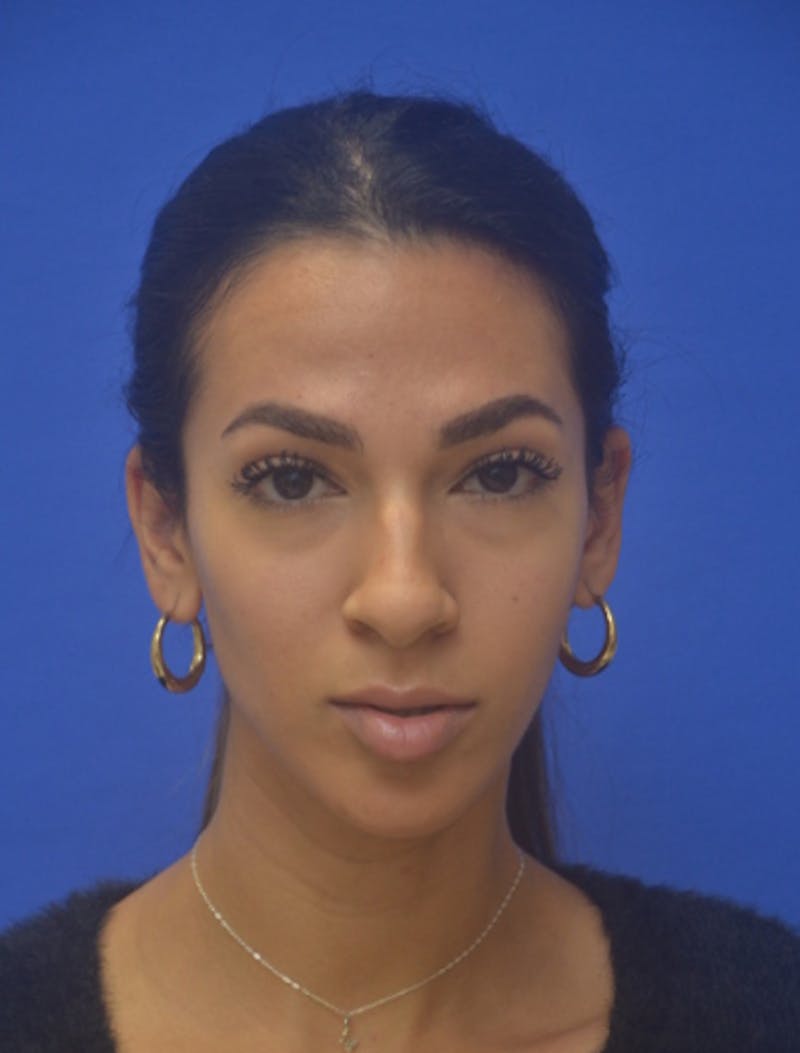 Rhinoplasty Before & After Gallery - Patient 262633 - Image 9