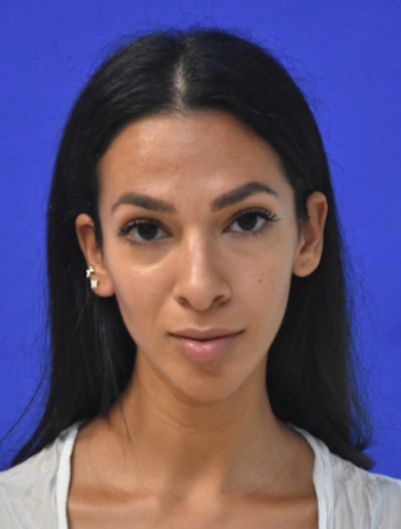 Rhinoplasty Before & After Gallery - Patient 262633 - Image 10