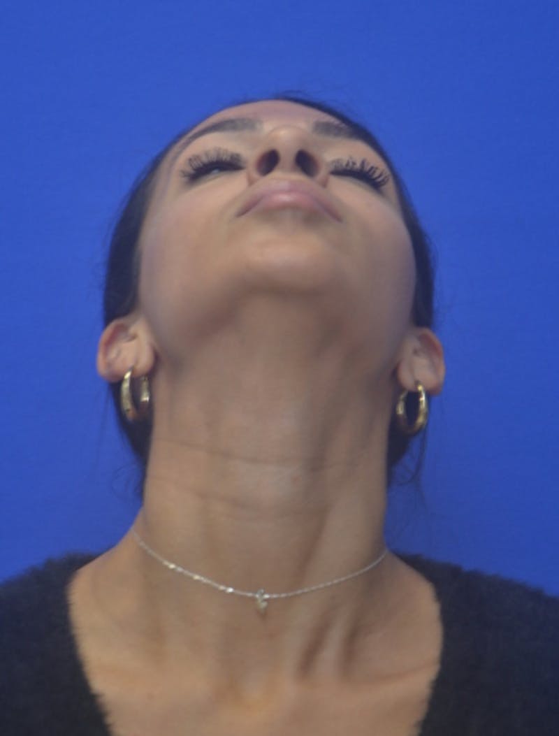 Rhinoplasty Before & After Gallery - Patient 262633 - Image 11