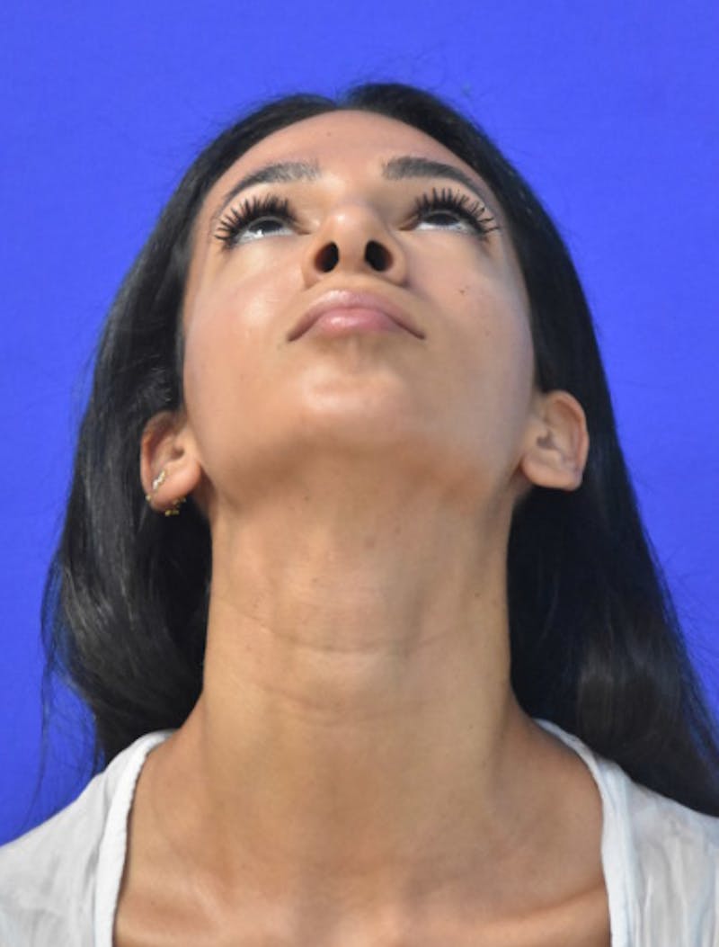 Rhinoplasty Before & After Gallery - Patient 262633 - Image 12