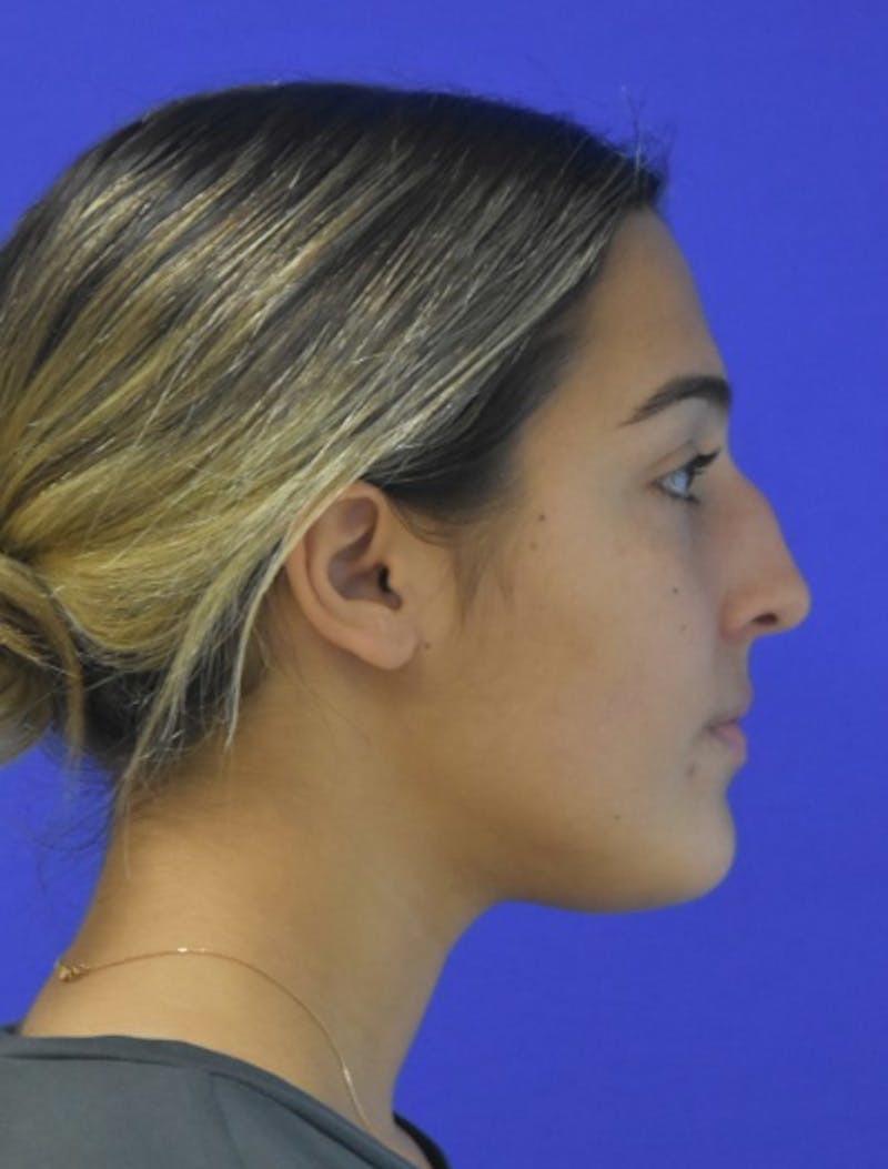 Rhinoplasty Before & After Gallery - Patient 337045 - Image 1