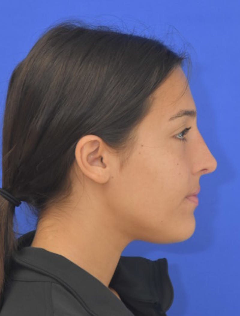Rhinoplasty Before & After Gallery - Patient 337045 - Image 2