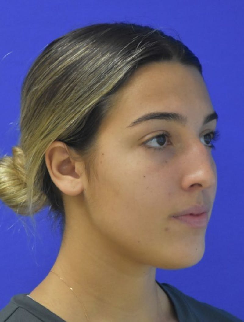 Rhinoplasty Before & After Gallery - Patient 337045 - Image 3