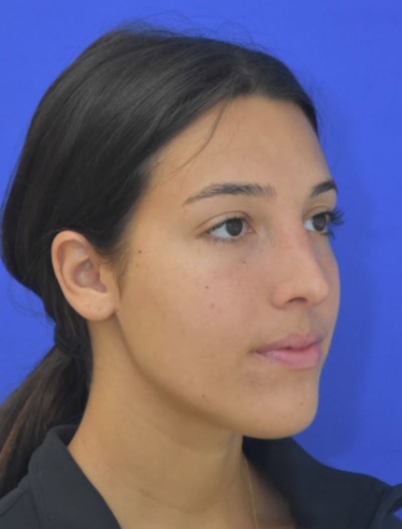 Rhinoplasty Before & After Gallery - Patient 337045 - Image 4
