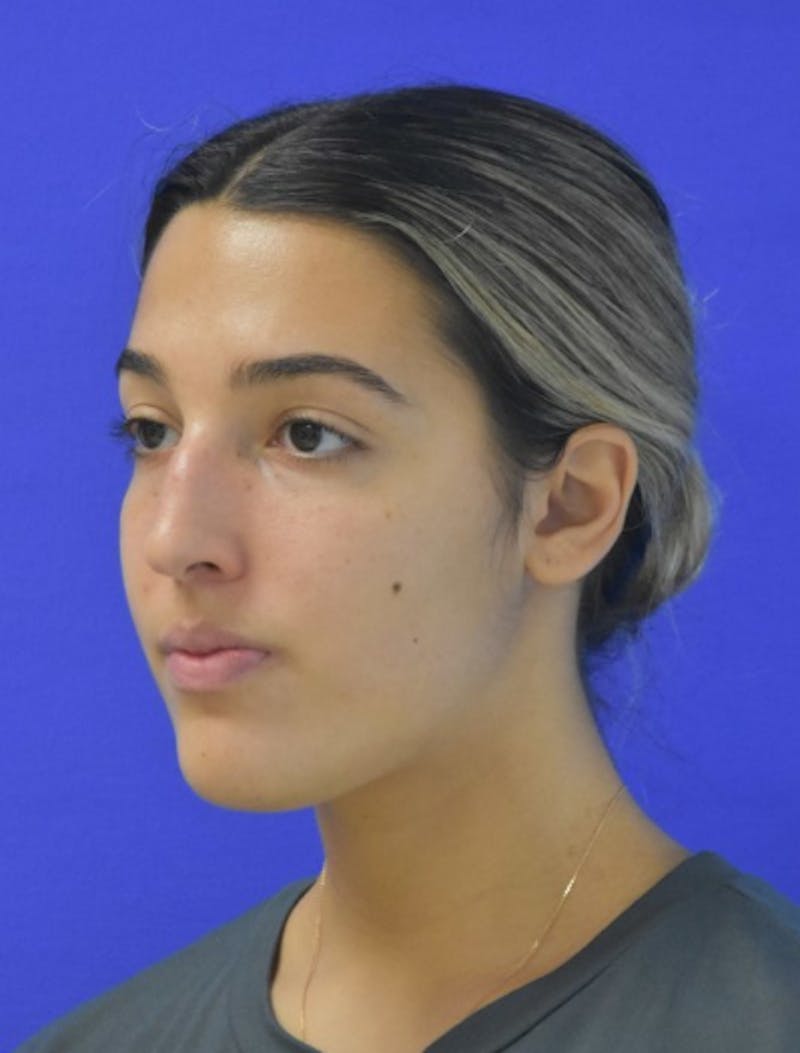 Rhinoplasty Before & After Gallery - Patient 337045 - Image 5