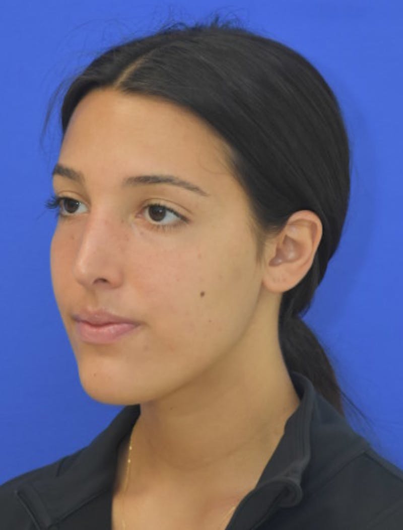 Rhinoplasty Before & After Gallery - Patient 337045 - Image 6