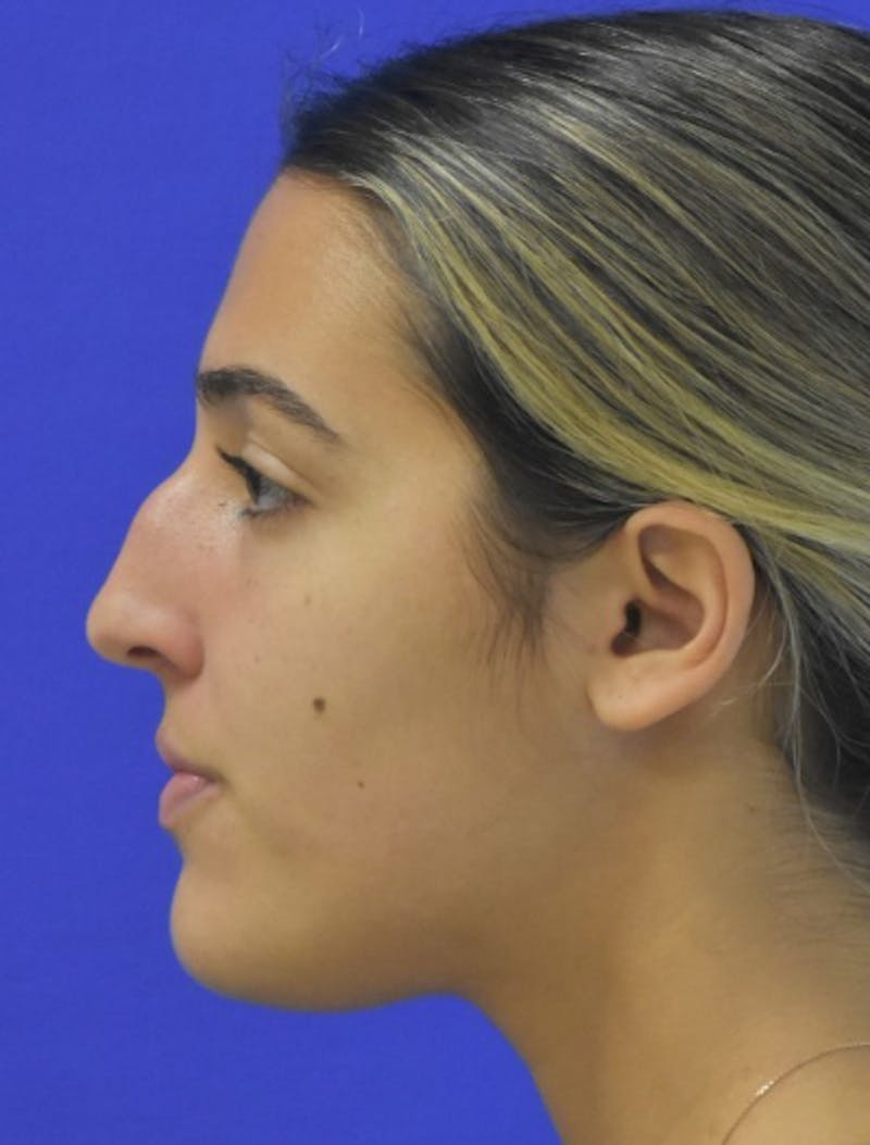 Rhinoplasty Before & After Gallery - Patient 337045 - Image 7