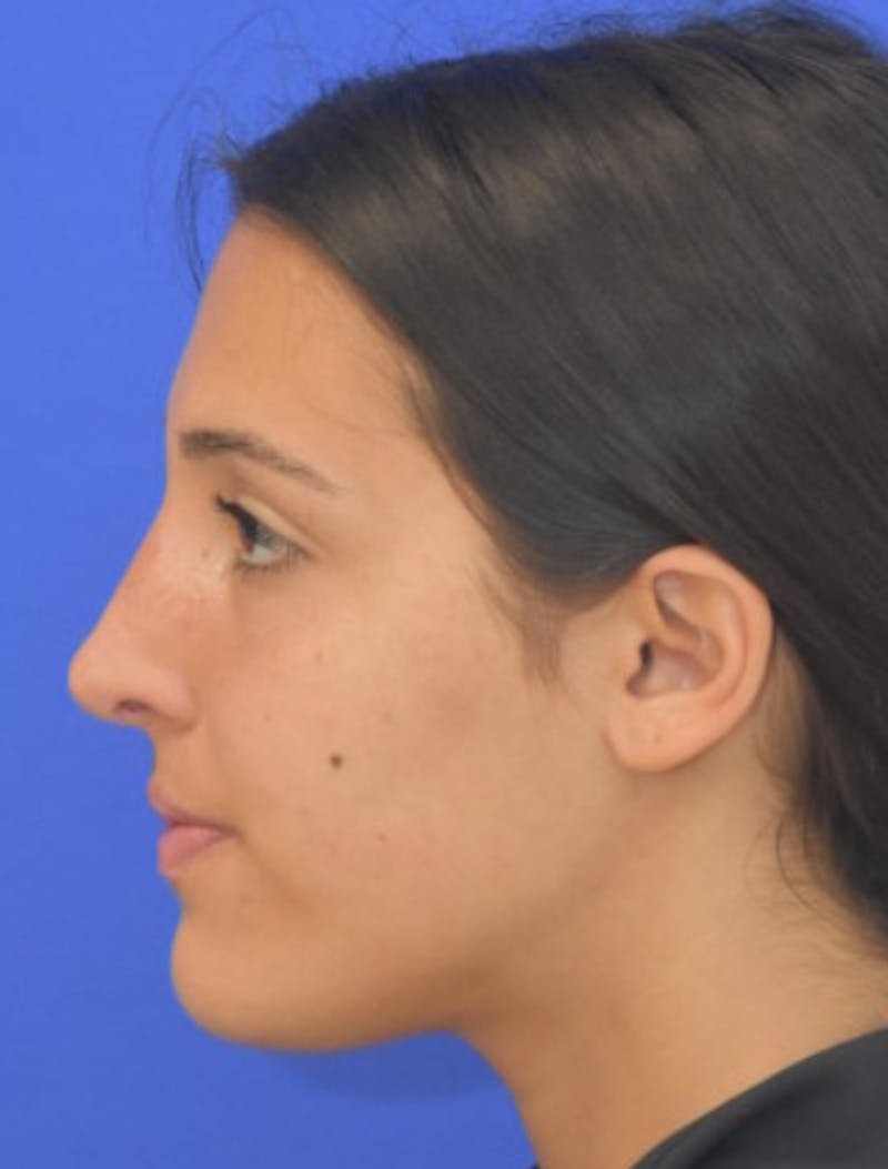 Rhinoplasty Before & After Gallery - Patient 337045 - Image 8