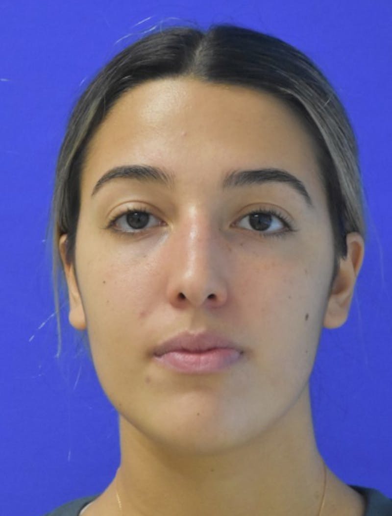 Rhinoplasty Before & After Gallery - Patient 337045 - Image 9