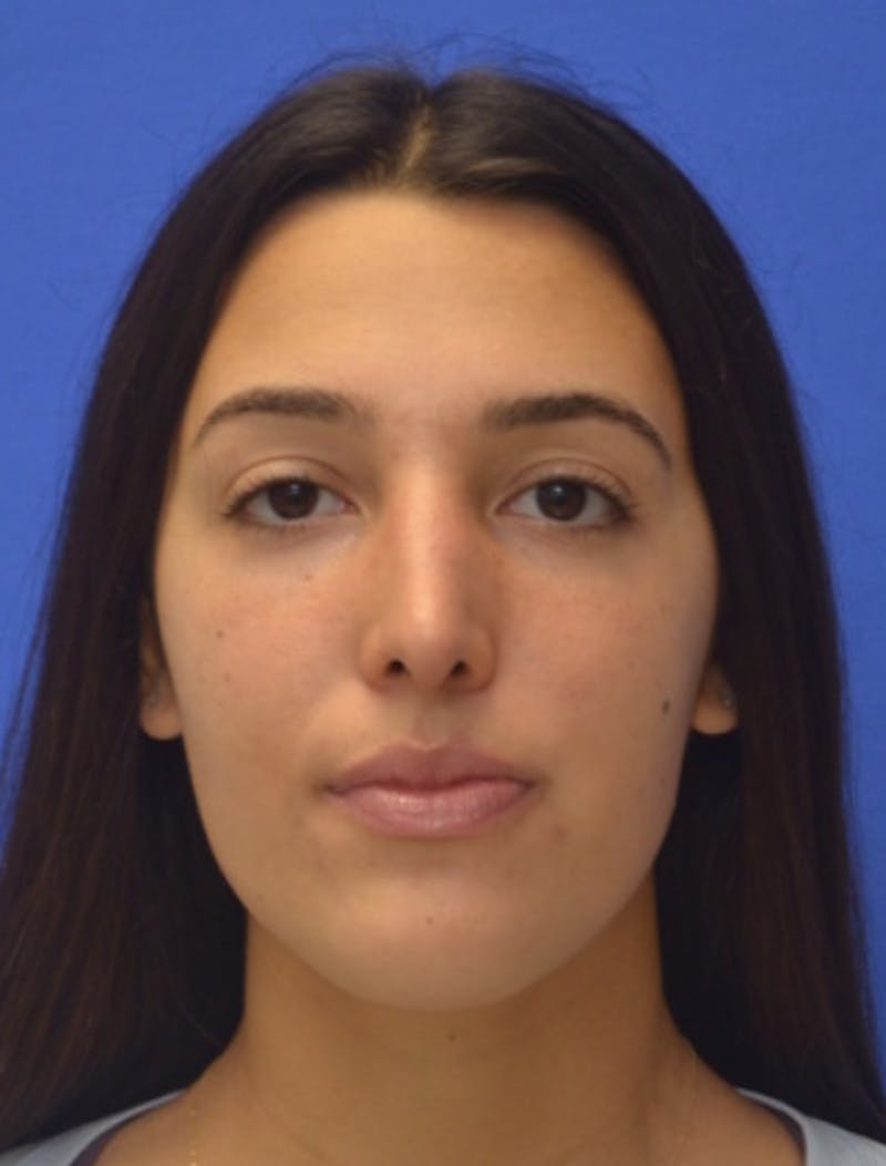 Rhinoplasty Before & After Gallery - Patient 337045 - Image 10