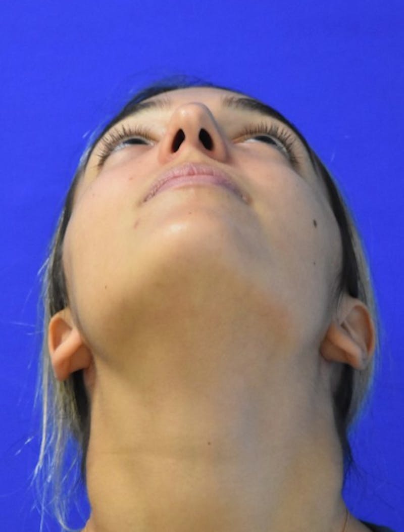 Rhinoplasty Before & After Gallery - Patient 337045 - Image 11