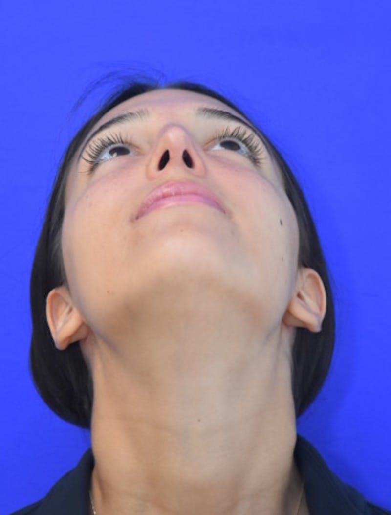 Rhinoplasty Before & After Gallery - Patient 337045 - Image 12