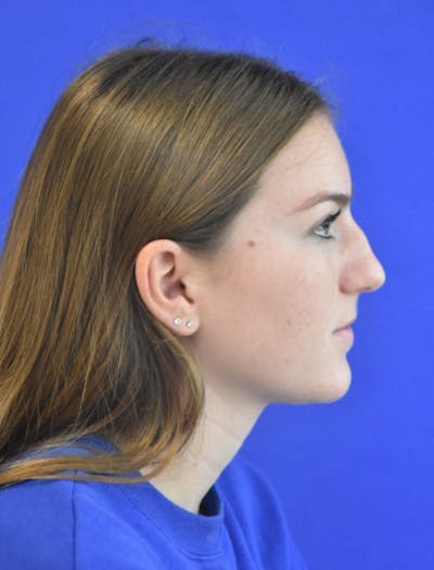 Rhinoplasty Before & After Gallery - Patient 158678 - Image 1
